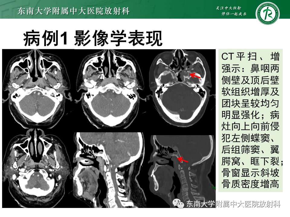 影像PPT - 【PPT】鼻咽癌影像及分期-8