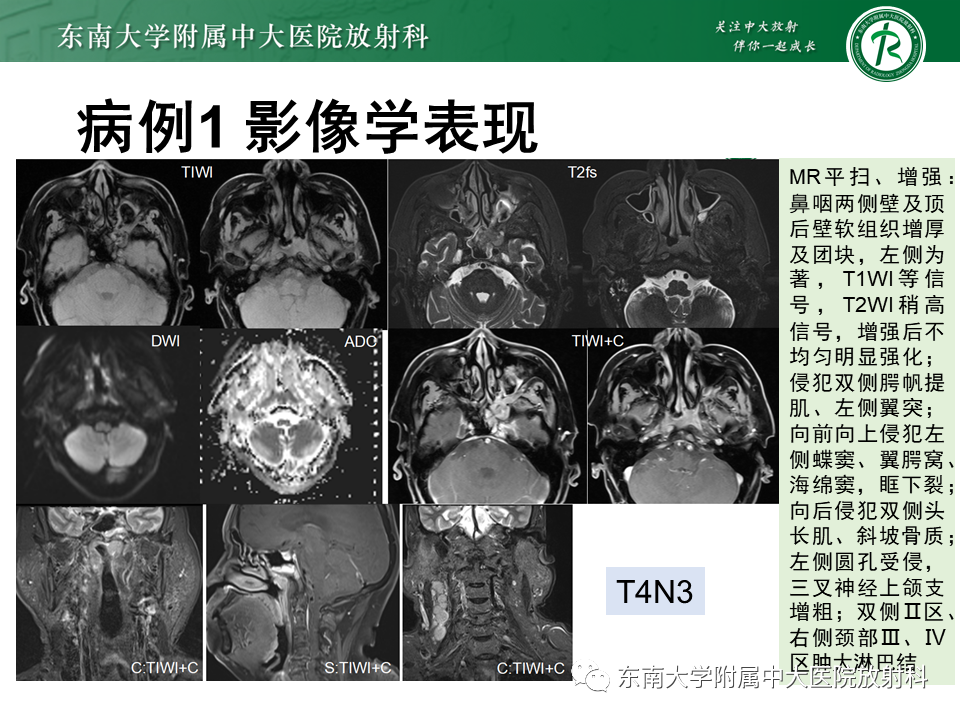 影像PPT - 【PPT】鼻咽癌影像及分期-9