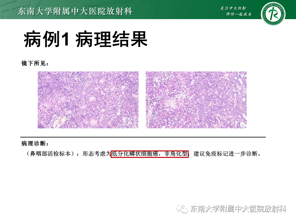 影像PPT - 【PPT】鼻咽癌影像及分期-10