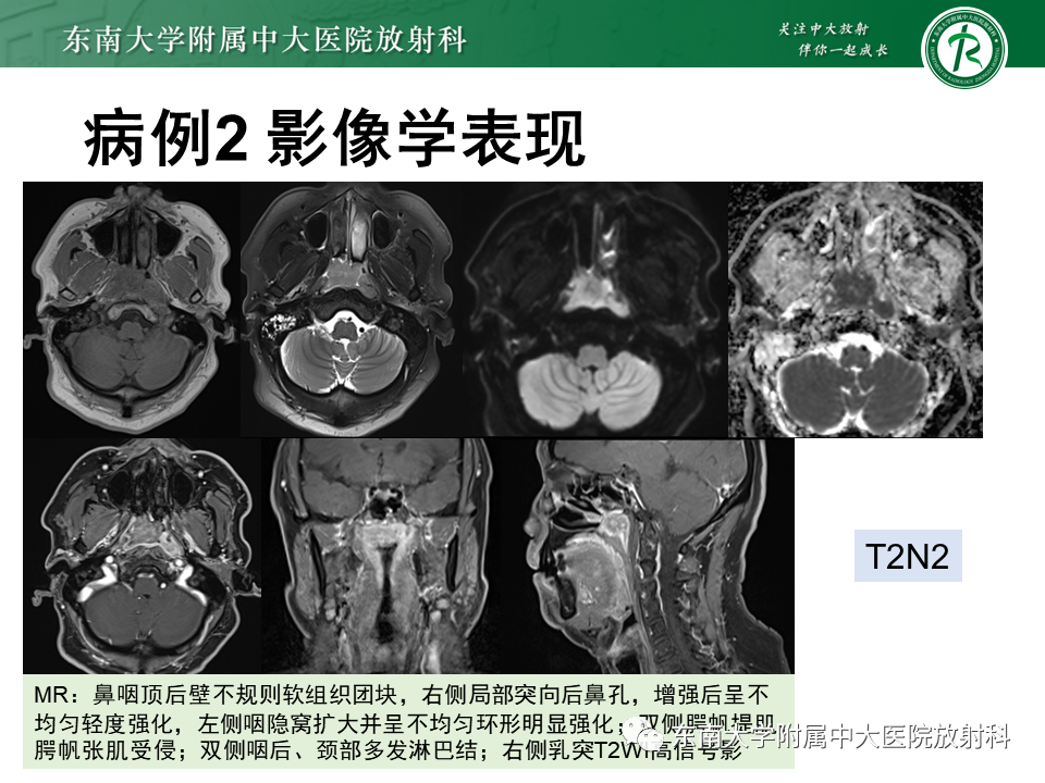 影像PPT - 【PPT】鼻咽癌影像及分期-11