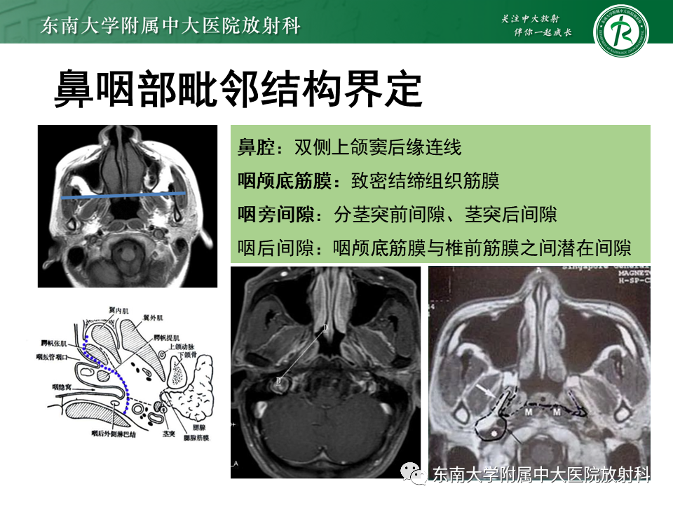 影像PPT - 【PPT】鼻咽癌影像及分期-16