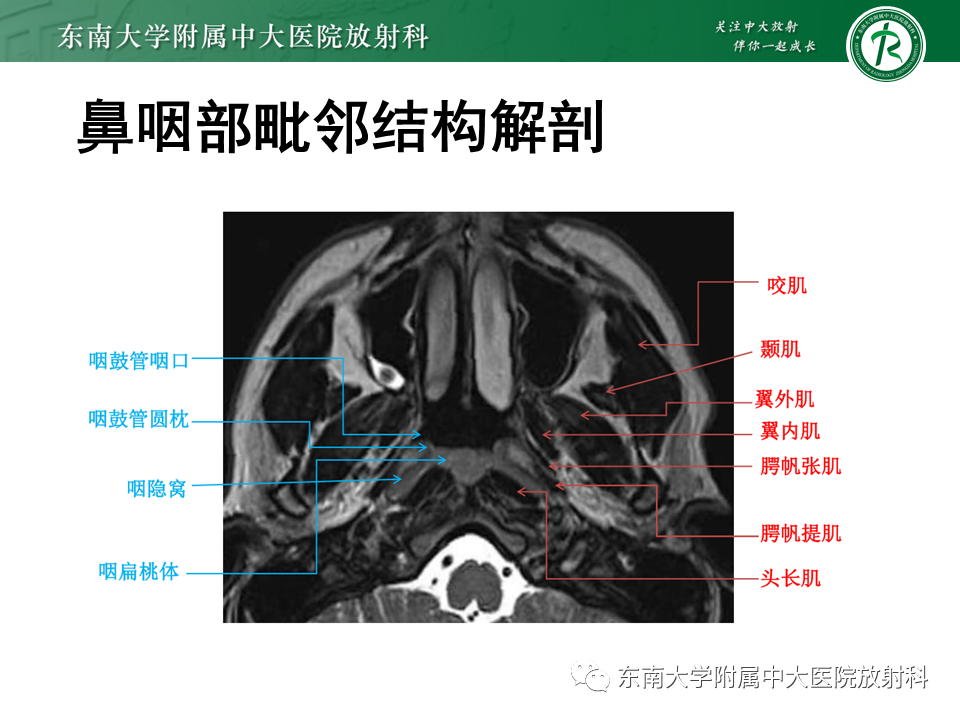 影像PPT - 【PPT】鼻咽癌影像及分期-17