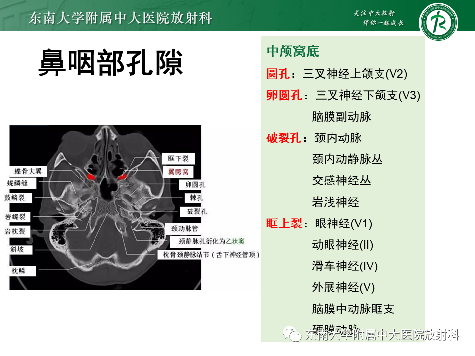 影像PPT - 【PPT】鼻咽癌影像及分期-19