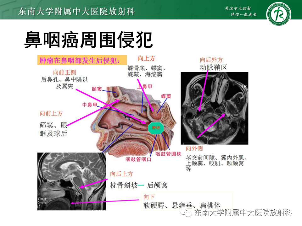 影像PPT - 【PPT】鼻咽癌影像及分期-22