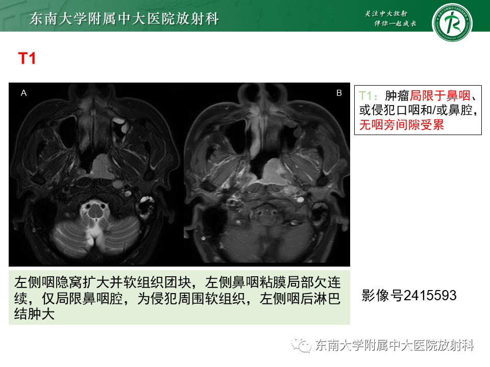 影像PPT - 【PPT】鼻咽癌影像及分期-28