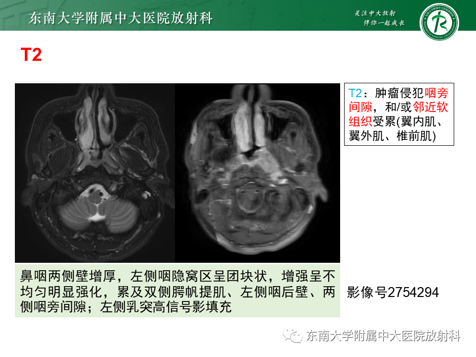 影像PPT - 【PPT】鼻咽癌影像及分期-29
