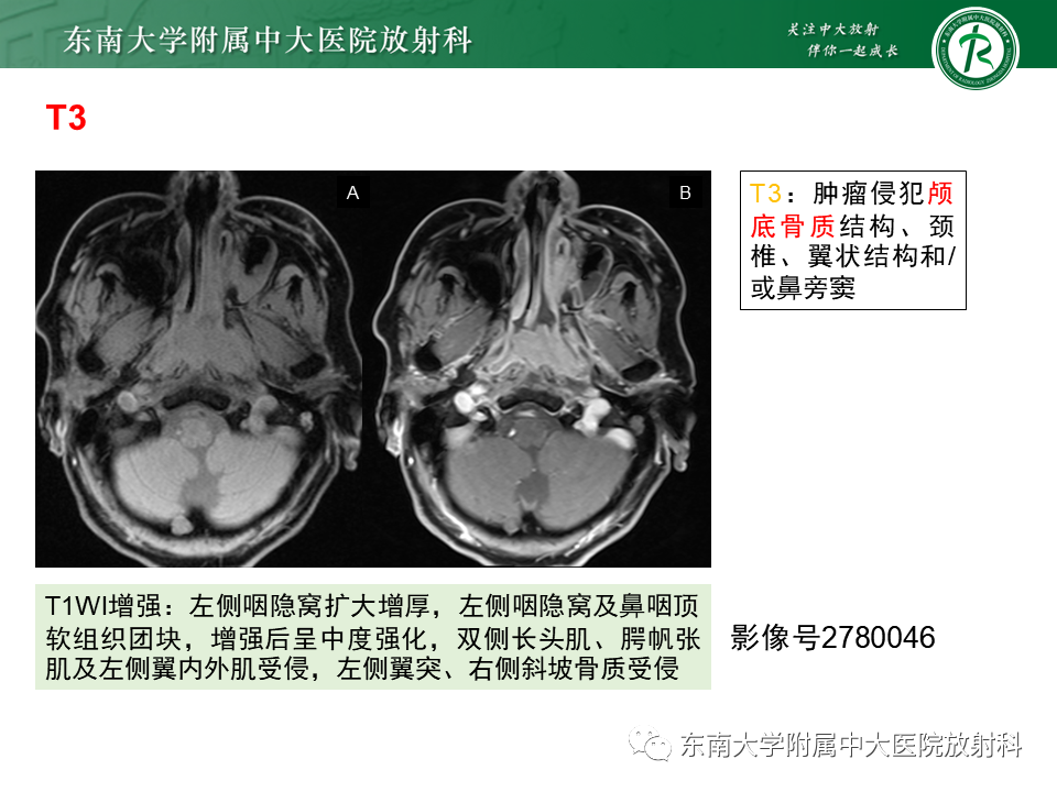 影像PPT - 【PPT】鼻咽癌影像及分期-30
