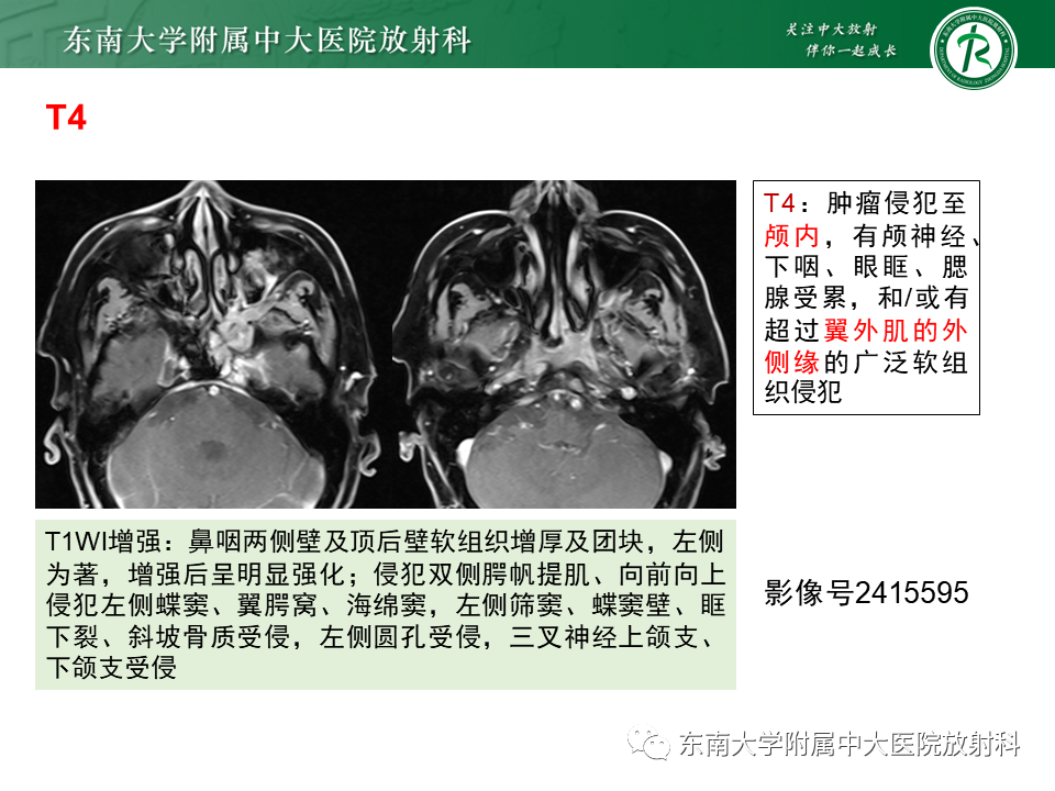 影像PPT - 【PPT】鼻咽癌影像及分期-31
