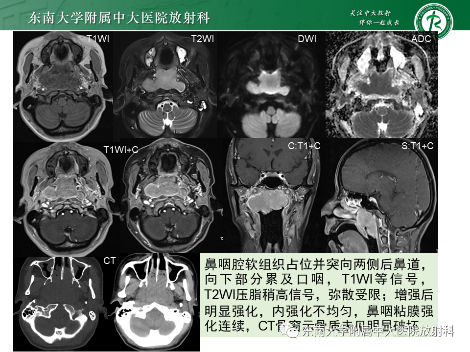 影像PPT - 【PPT】鼻咽癌影像及分期-38