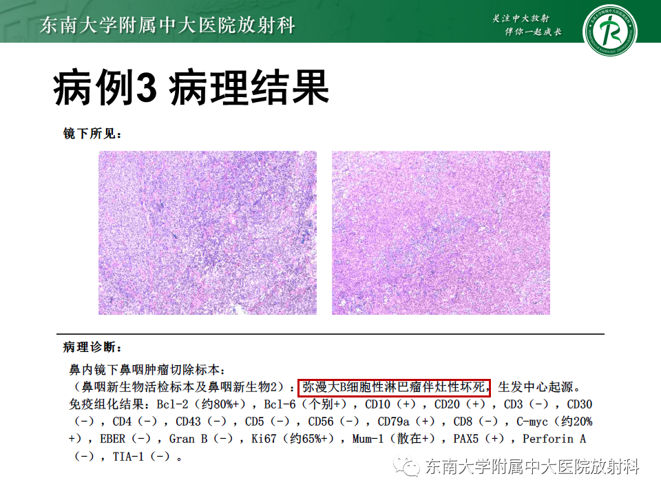 影像PPT - 【PPT】鼻咽癌影像及分期-39