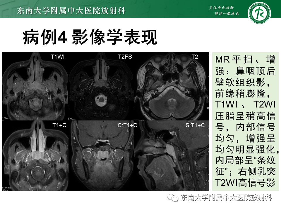 影像PPT - 【PPT】鼻咽癌影像及分期-43