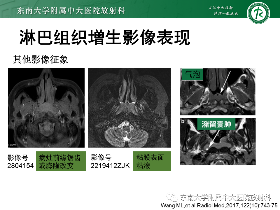 影像PPT - 【PPT】鼻咽癌影像及分期-47