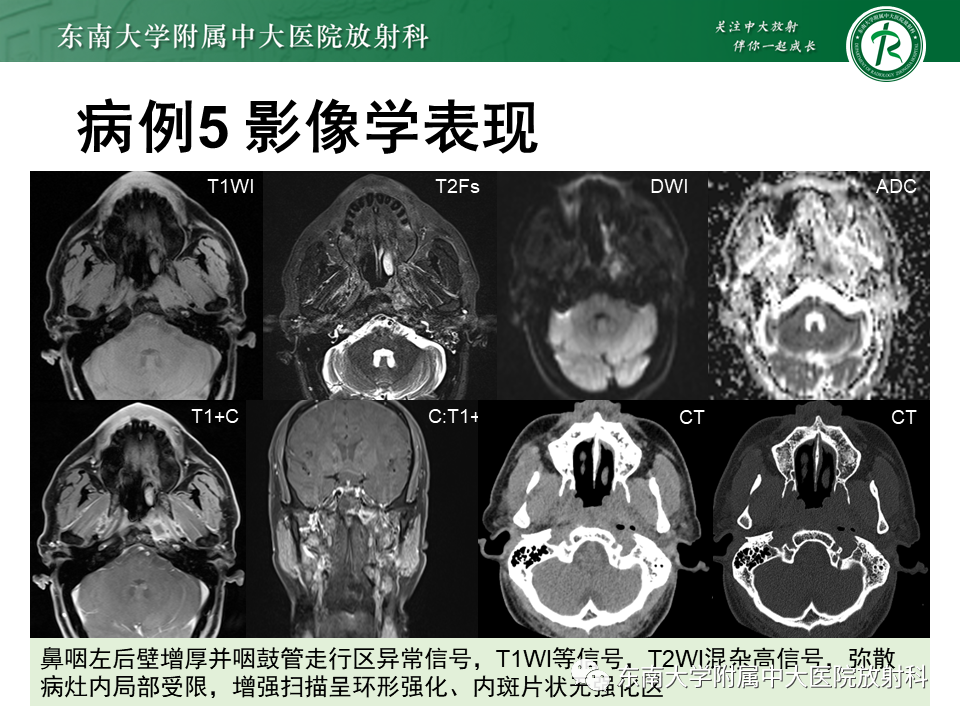 影像PPT - 【PPT】鼻咽癌影像及分期-50