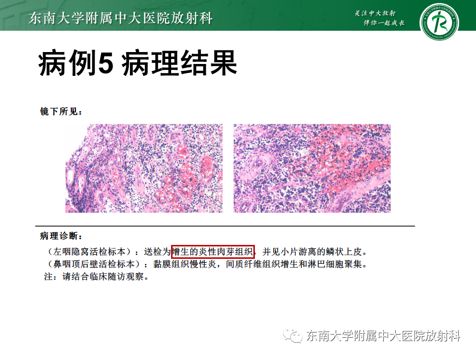 影像PPT - 【PPT】鼻咽癌影像及分期-51
