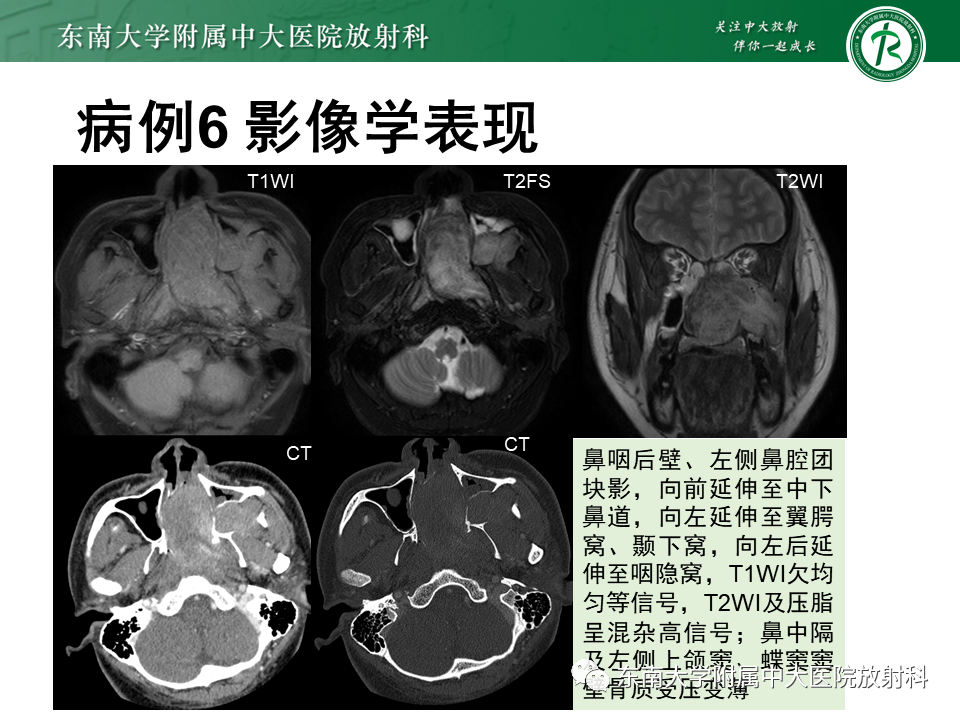 影像PPT - 【PPT】鼻咽癌影像及分期-54