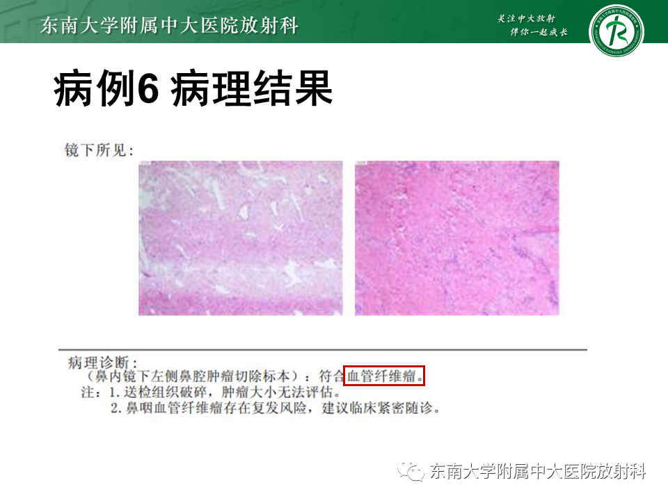 影像PPT - 【PPT】鼻咽癌影像及分期-55