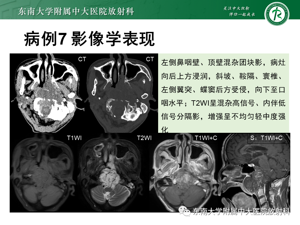 影像PPT - 【PPT】鼻咽癌影像及分期-58