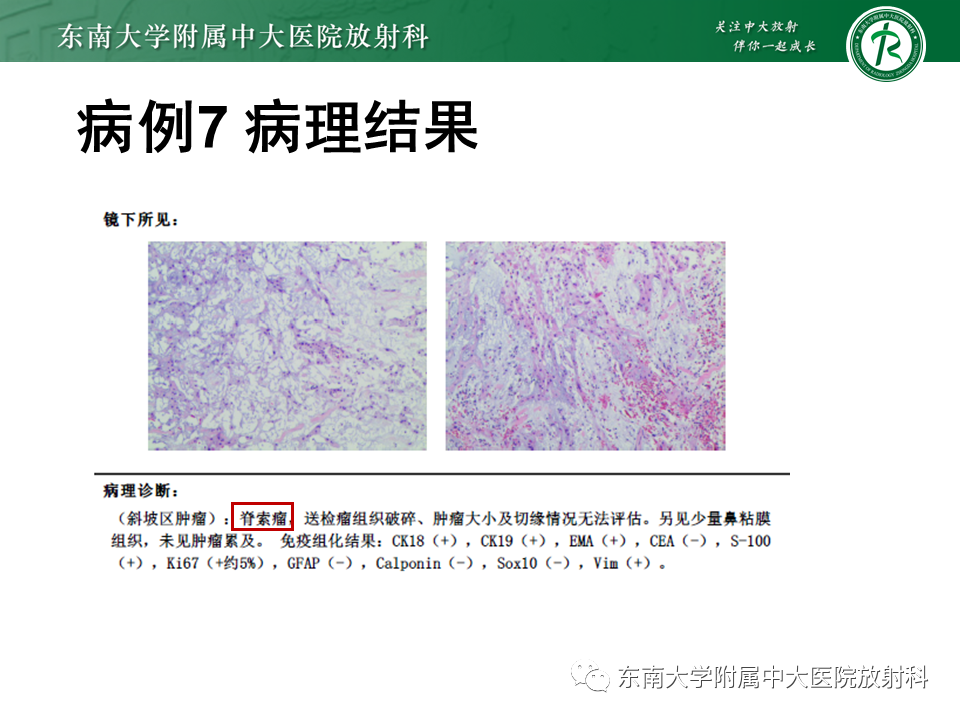 影像PPT - 【PPT】鼻咽癌影像及分期-59