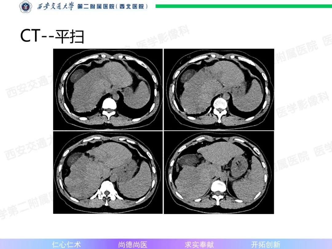 影像PPT - 【病例】肝融合性纤维化1例CT及MR影像-3