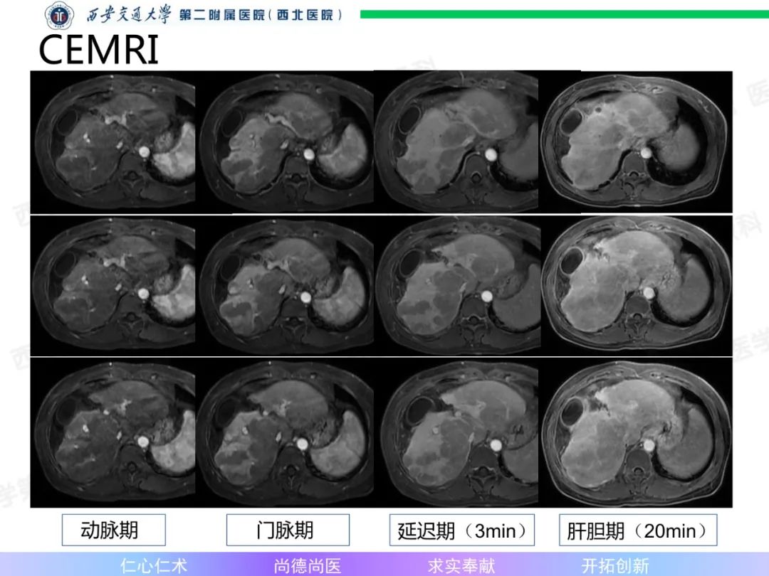 影像PPT - 【病例】肝融合性纤维化1例CT及MR影像-6