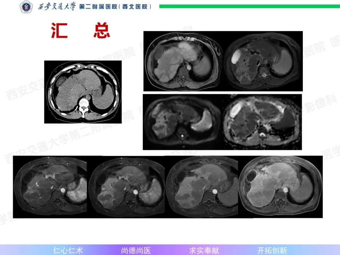 影像PPT - 【病例】肝融合性纤维化1例CT及MR影像-7