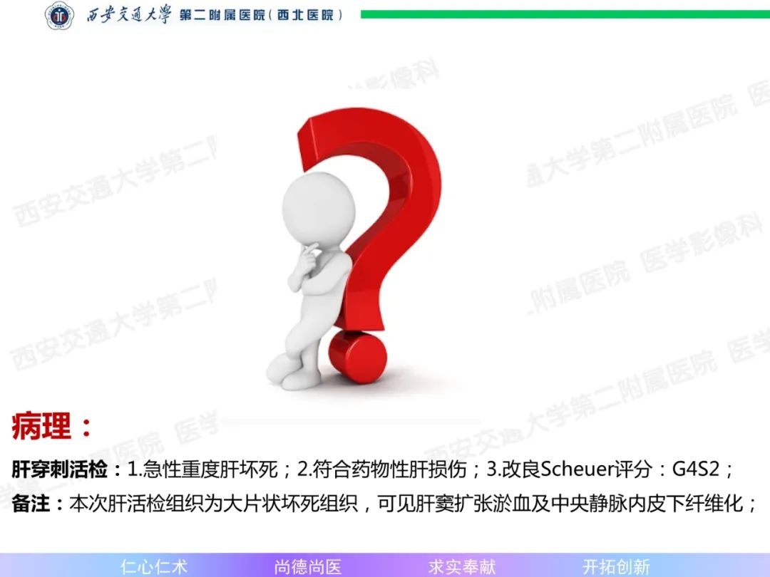 影像PPT - 【病例】肝融合性纤维化1例CT及MR影像-8