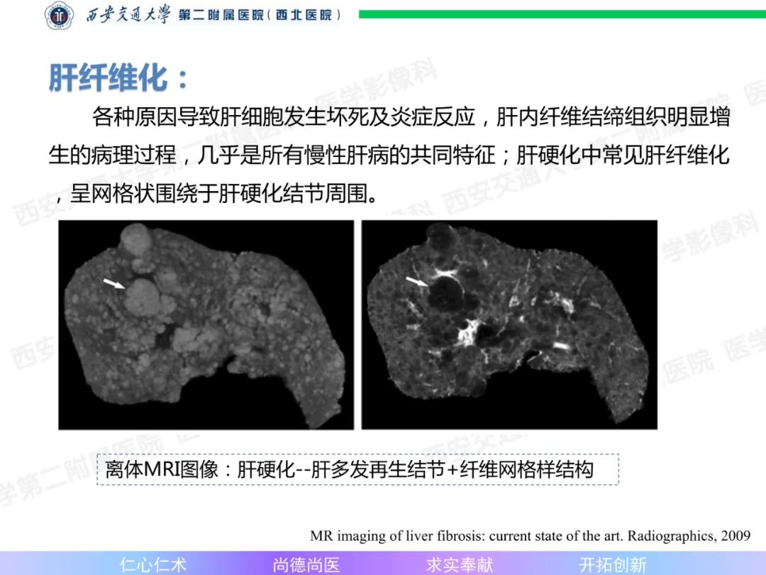 影像PPT - 【病例】肝融合性纤维化1例CT及MR影像-10