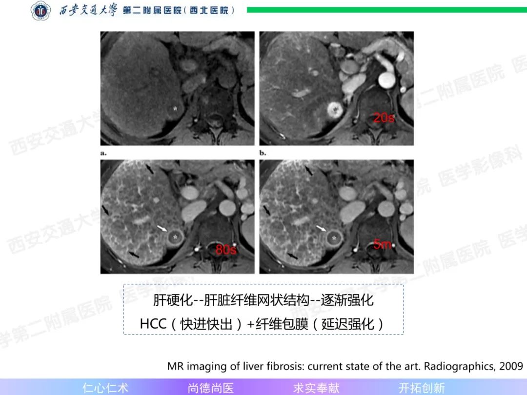影像PPT - 【病例】肝融合性纤维化1例CT及MR影像-11