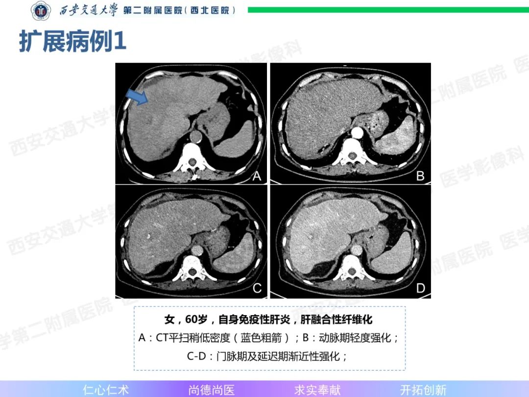 影像PPT - 【病例】肝融合性纤维化1例CT及MR影像-15