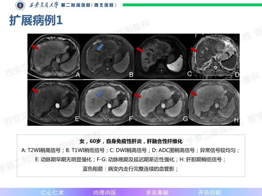 影像PPT - 【病例】肝融合性纤维化1例CT及MR影像-16