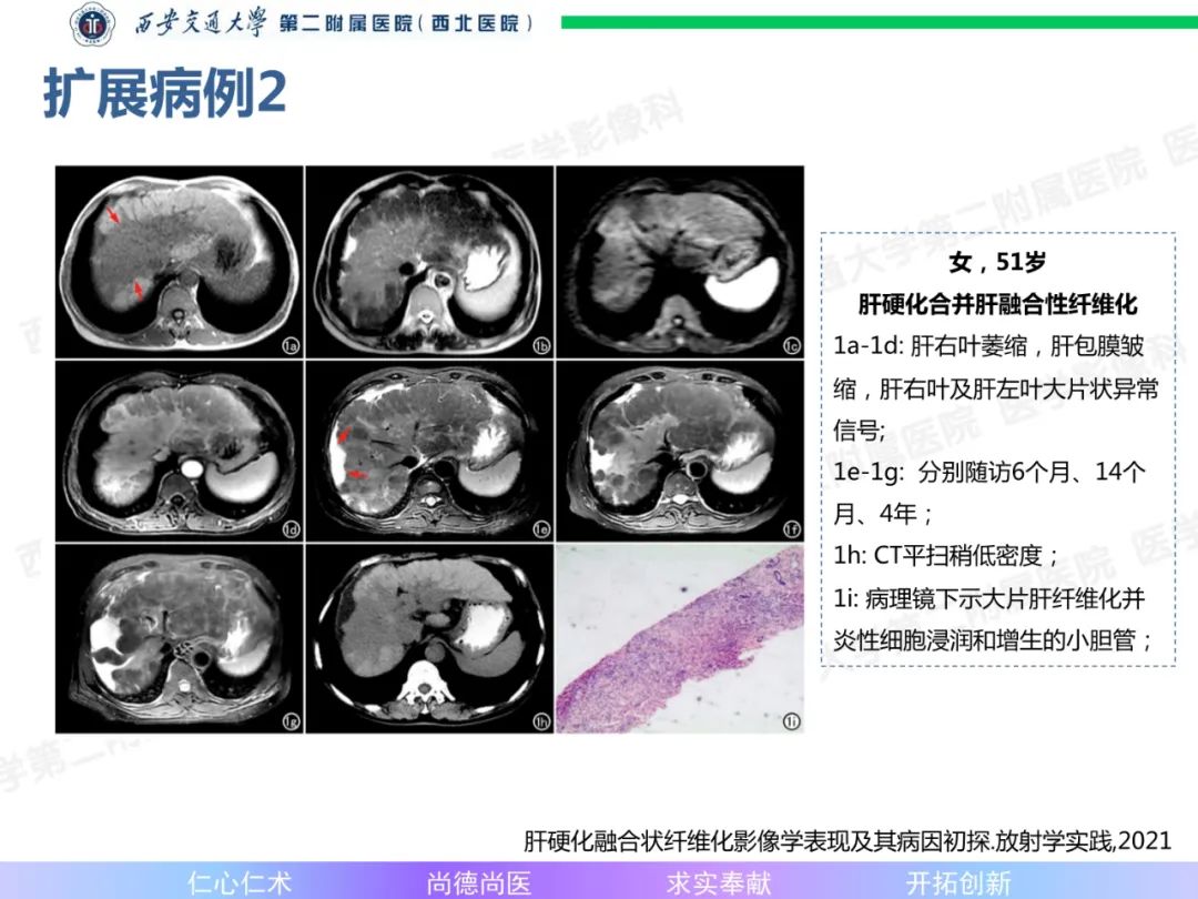 影像PPT - 【病例】肝融合性纤维化1例CT及MR影像-17