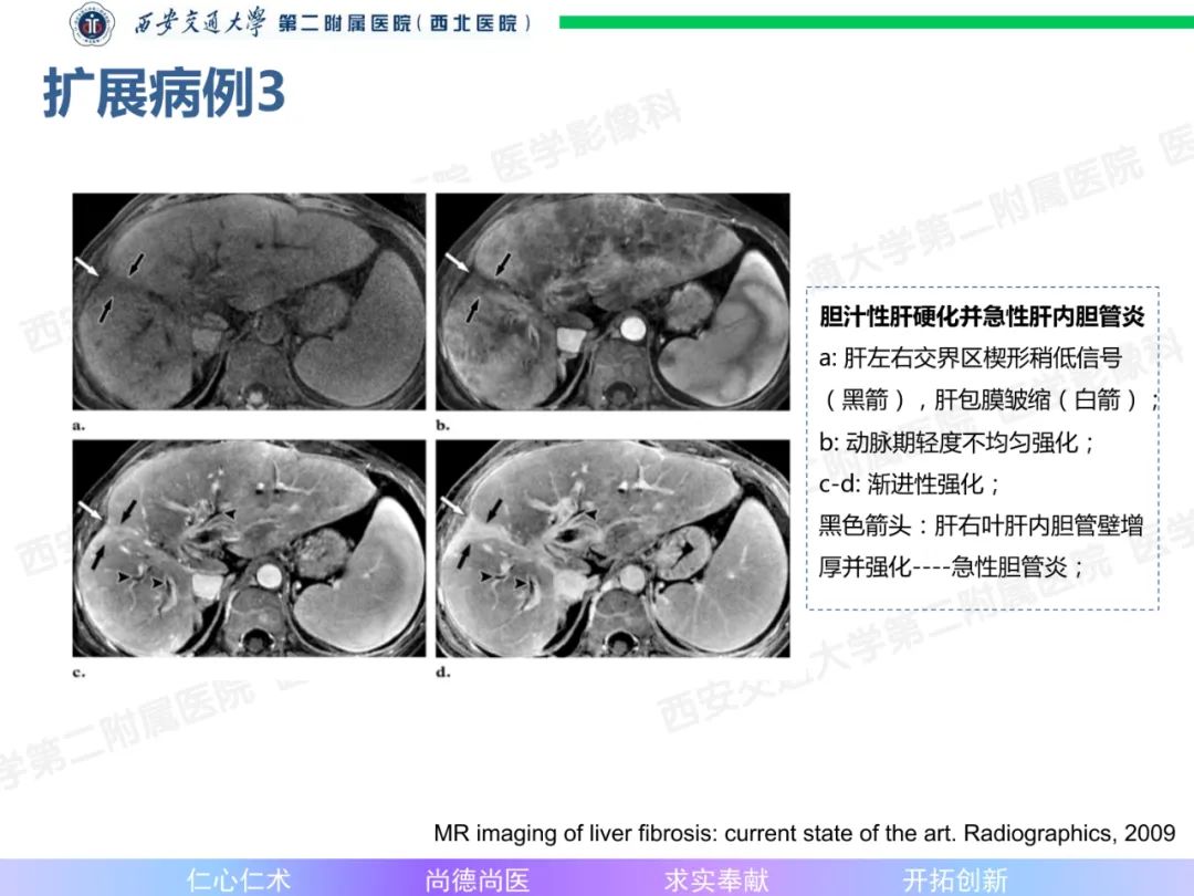 影像PPT - 【病例】肝融合性纤维化1例CT及MR影像-18