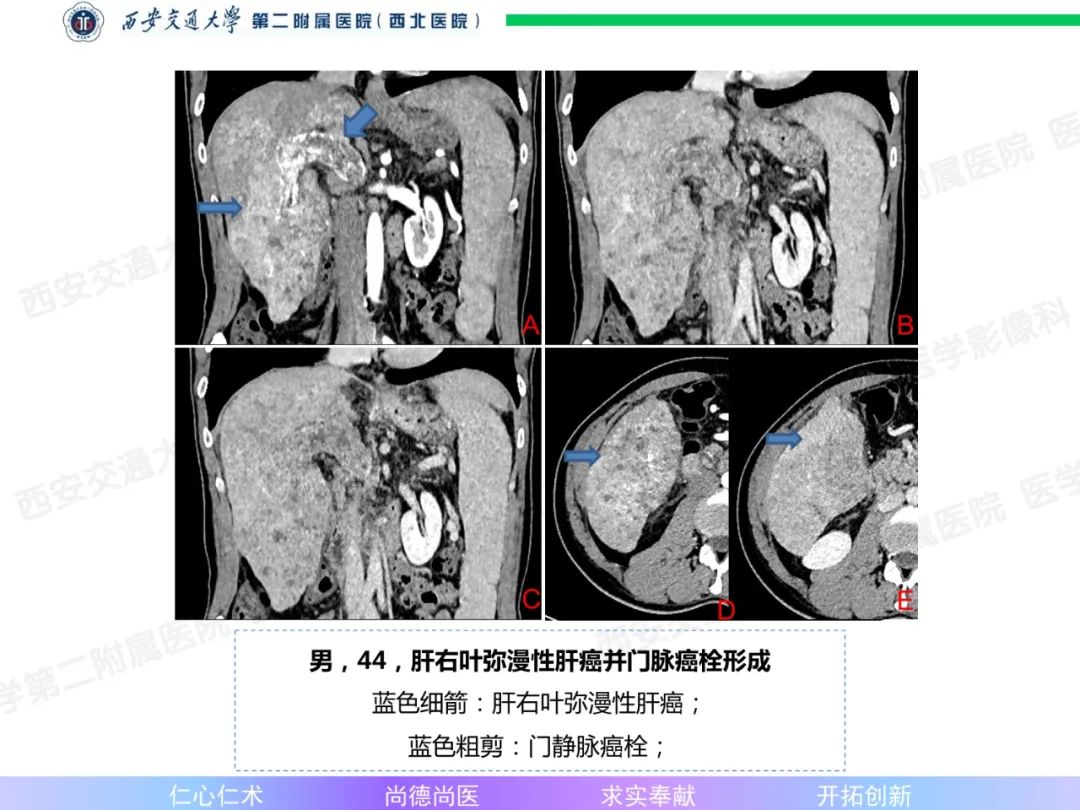 影像PPT - 【病例】肝融合性纤维化1例CT及MR影像-21