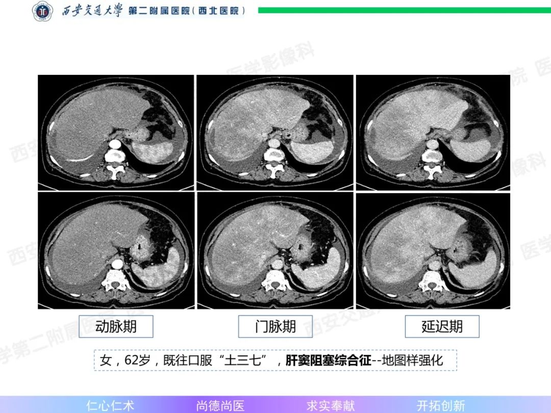 影像PPT - 【病例】肝融合性纤维化1例CT及MR影像-24