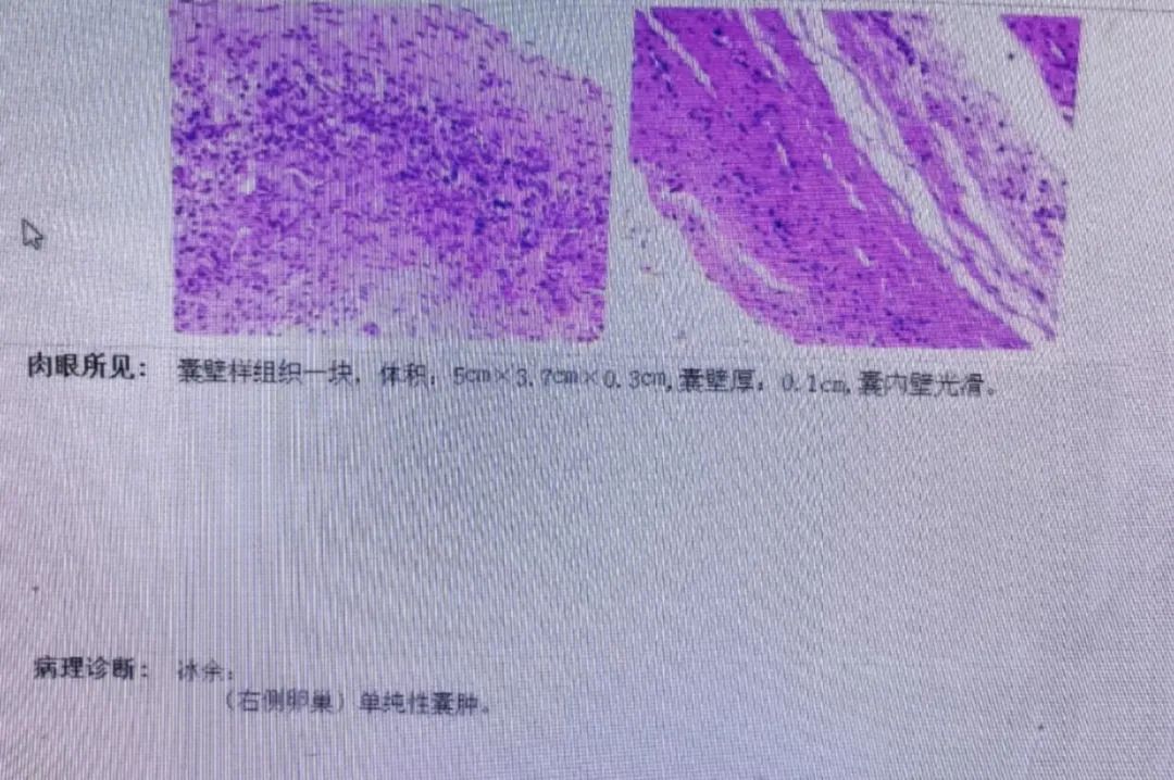 影像PPT - 【病例】卵巢囊肿蒂扭转1例MR影像特点回顾-4 影像PPT - 【病例】卵巢囊肿蒂扭转1例MR影像特点回顾-4