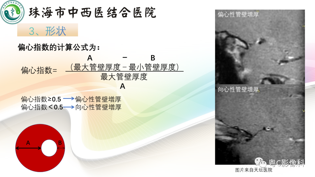 影像PPT - 【PPT】颅内MR血管壁高分辨成像的应用——中国专家共识-9