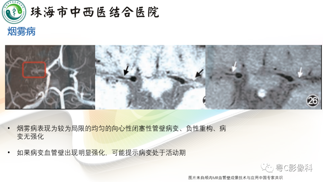 影像PPT - 【PPT】颅内MR血管壁高分辨成像的应用——中国专家共识-26