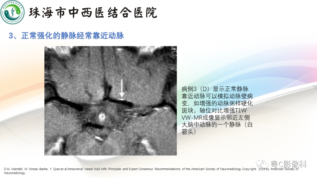 影像PPT - 【PPT】颅内MR血管壁高分辨成像的应用——中国专家共识-32