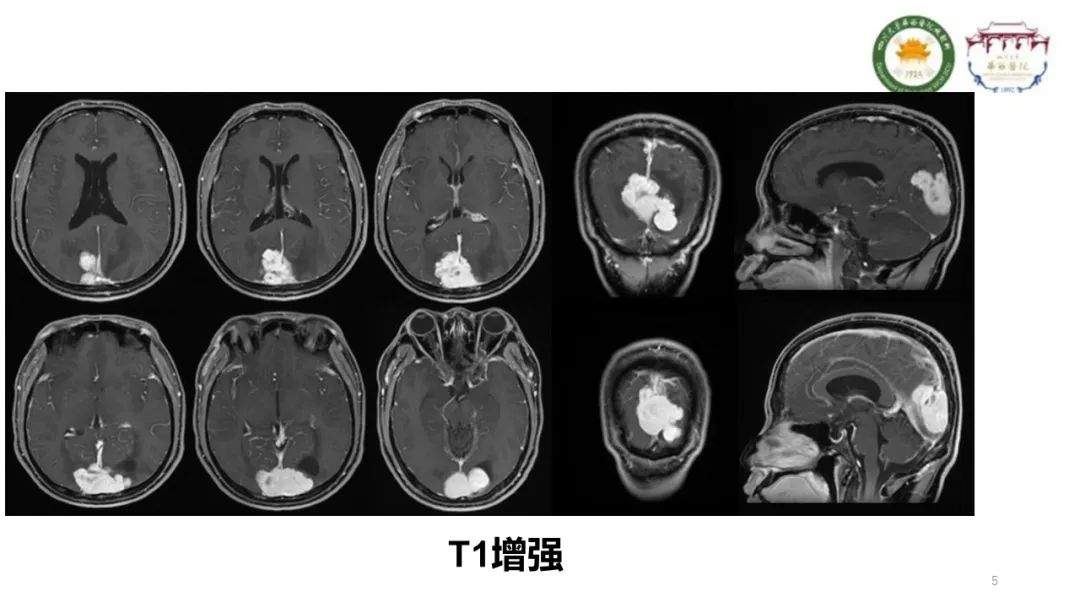 影像PPT - 【病例】颅内孤立性纤维性肿瘤1例MR影像-5