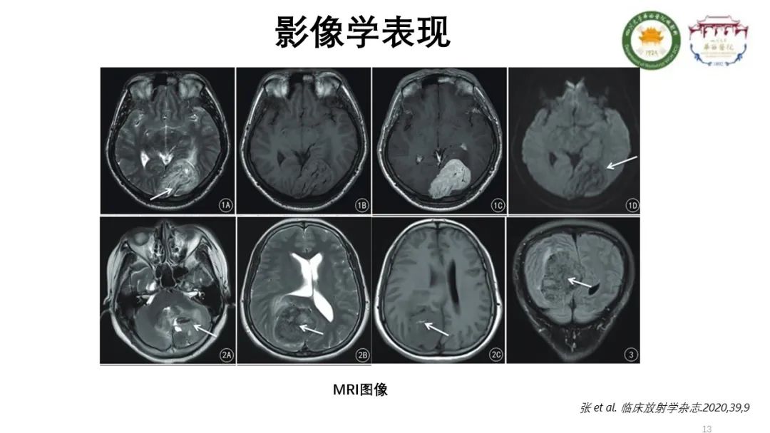 影像PPT - 【病例】颅内孤立性纤维性肿瘤1例MR影像-13