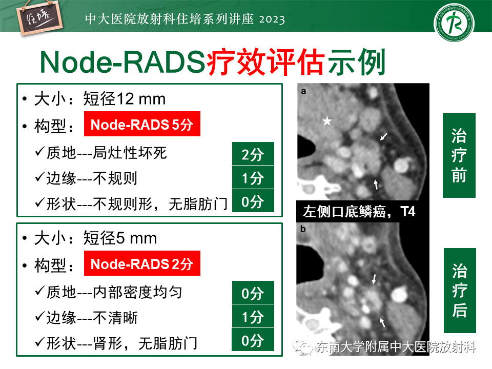 影像PPT - 【PPT】Node-RADS 1.0癌中淋巴结标准化评估-35
