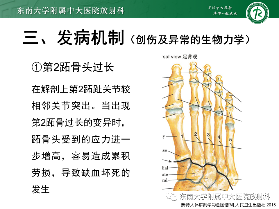 影像PPT - 【PPT】Freiberg病（跖骨头缺血性坏死）-7