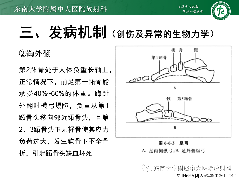 影像PPT - 【PPT】Freiberg病（跖骨头缺血性坏死）-8