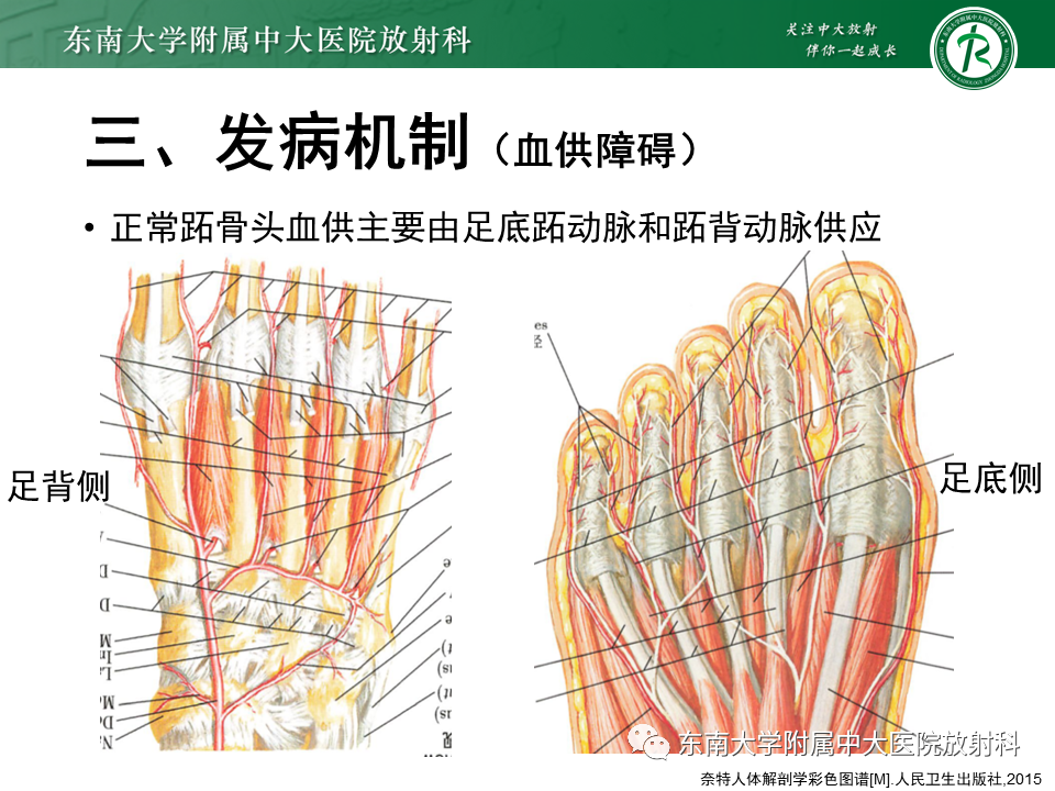 影像PPT - 【PPT】Freiberg病（跖骨头缺血性坏死）-10