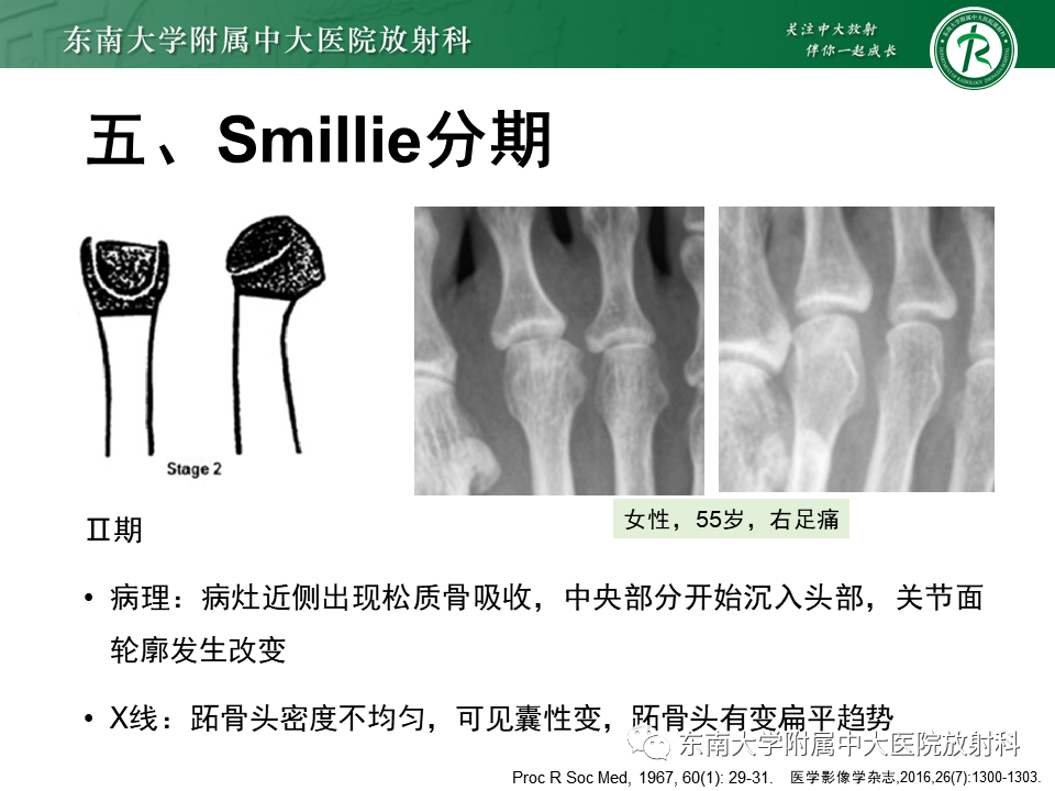 影像PPT - 【PPT】Freiberg病（跖骨头缺血性坏死）-19