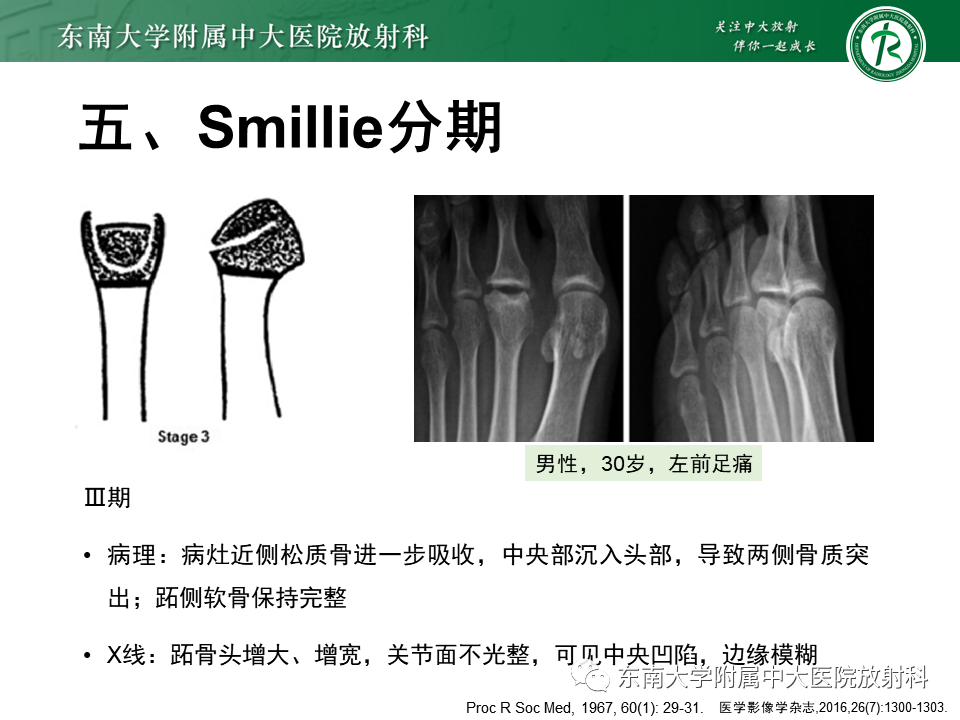 影像PPT - 【PPT】Freiberg病（跖骨头缺血性坏死）-20