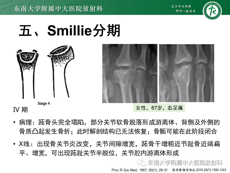 影像PPT - 【PPT】Freiberg病（跖骨头缺血性坏死）-21