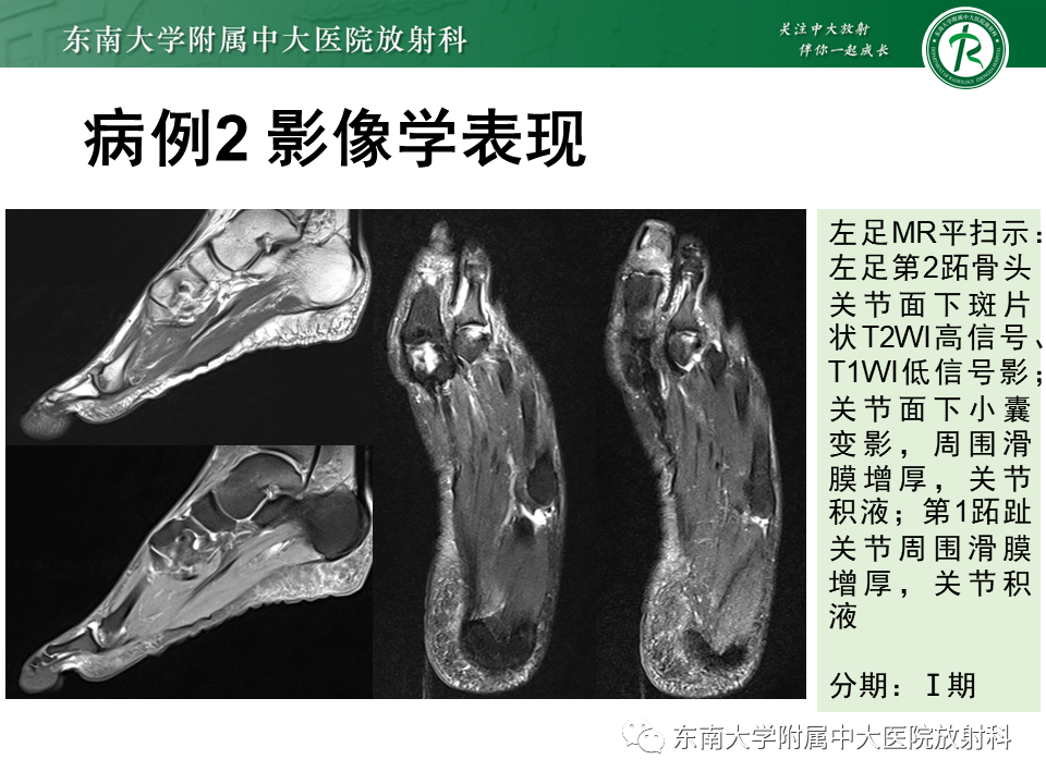 影像PPT - 【PPT】Freiberg病（跖骨头缺血性坏死）-26