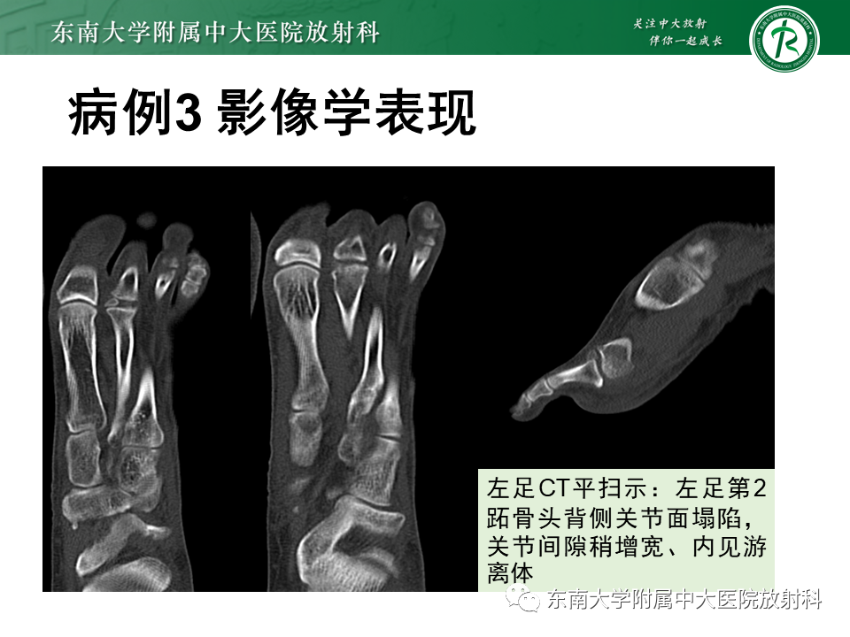 影像PPT - 【PPT】Freiberg病（跖骨头缺血性坏死）-28