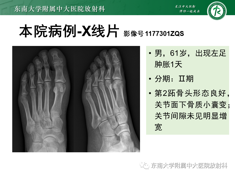 影像PPT - 【PPT】Freiberg病（跖骨头缺血性坏死）-31